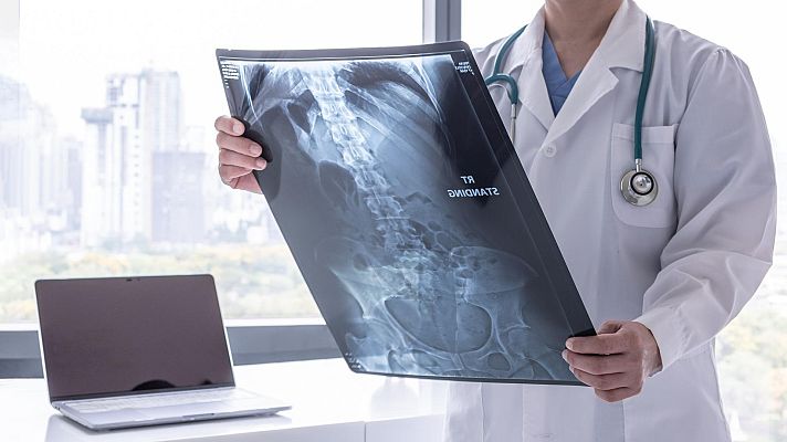 Telediario 2 - Un ensayo con inmunoterapia logra curar el cáncer de recto a 12 pacientes sin necesidad de quimio ni cirugía