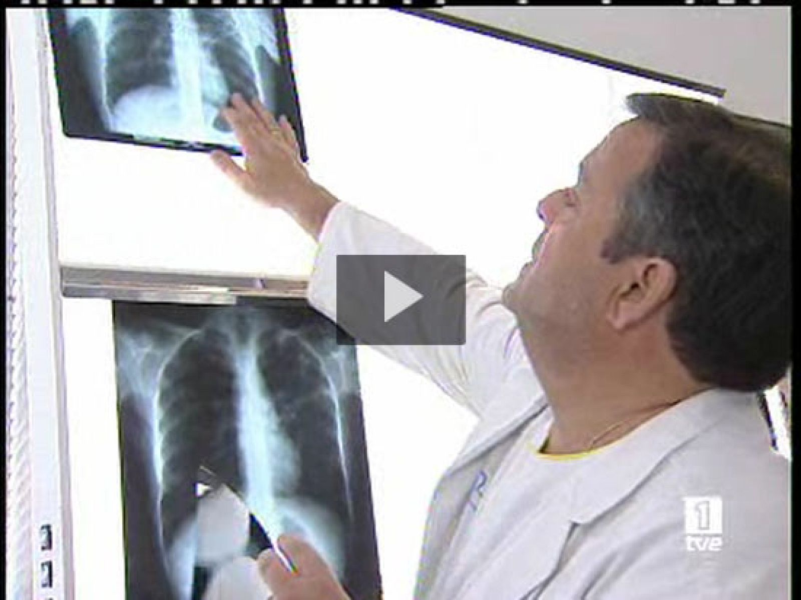 El coste del asma en España es superior al del sida y la tuberculosis juntos - Ciencia y tecnología en Rtve.es | Ver