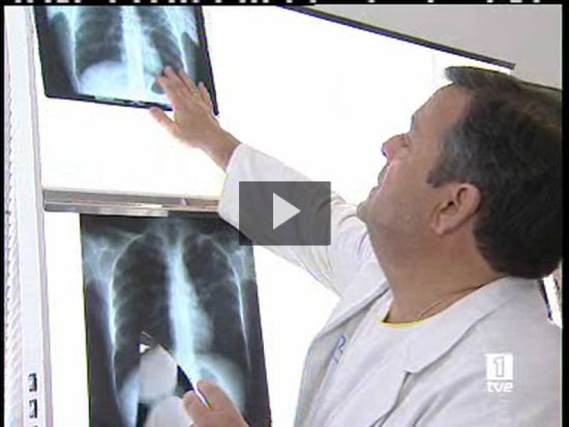 El coste del asma en España es superior al del sida y la tuberculosis juntos - Ciencia y tecnología en Rtve.es | Ver