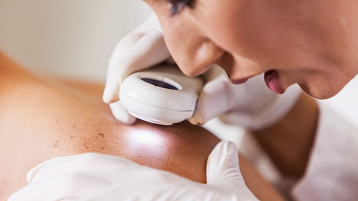 Telediario 1 - Día Mundial contra el Cáncer de Piel