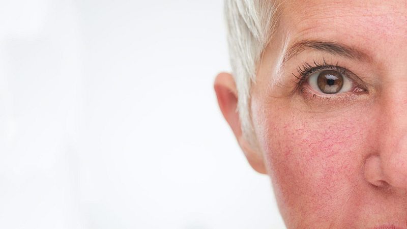 Flash Moda - Rosácea: el tratamiento más eficaz para borrar las marcas