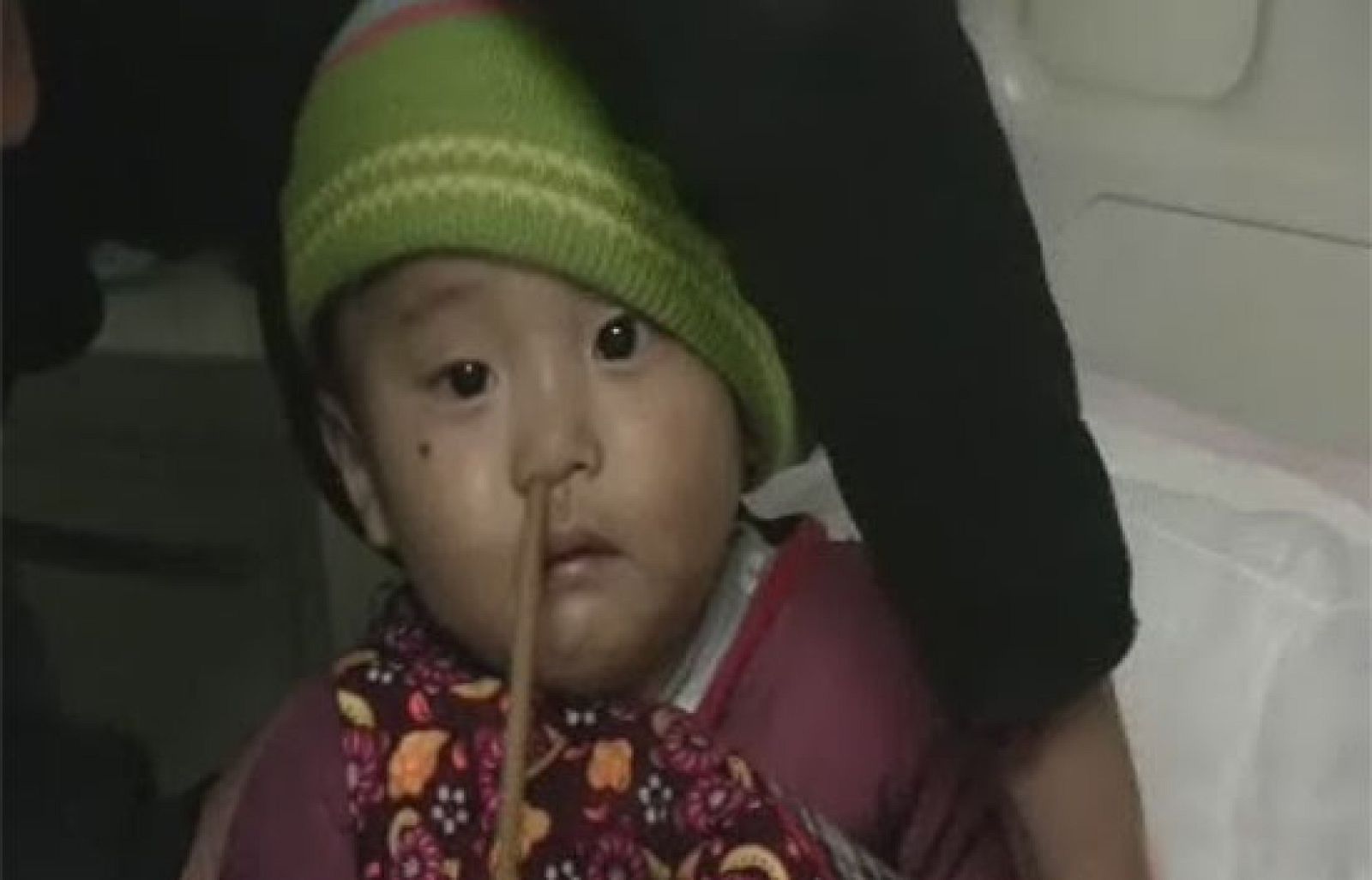 Un niño chino de cuatro años se mete un palillo accidentalmente por la nariz | Ver