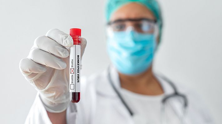 Telediario Fin de Semana - Dos muertes y más de 4.000 casos de viruela del mono en España