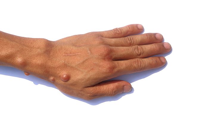 Telediario 2 - La doble estigmatización de las personas con neurofibromatosis con la irrupción de la viruela del mono