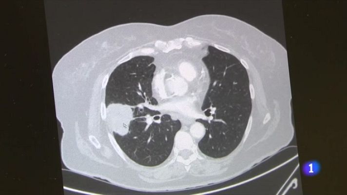 L'Informatiu - La medicina de precisió acorrala el càncer