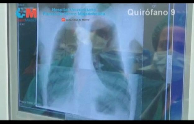 Ciencia y tecnología en Rtve.es - Avance en trasplantes de pulmón