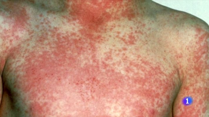 Telediario Fin de Semana - Casos de escarlatina en menores en Europa