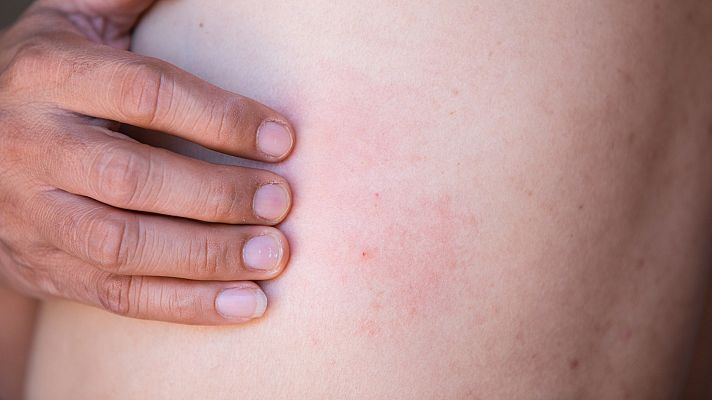 Hablando claro - Herpes Zóster, qué es y síntomas de una enfermedad que cada vez afecta a más personas