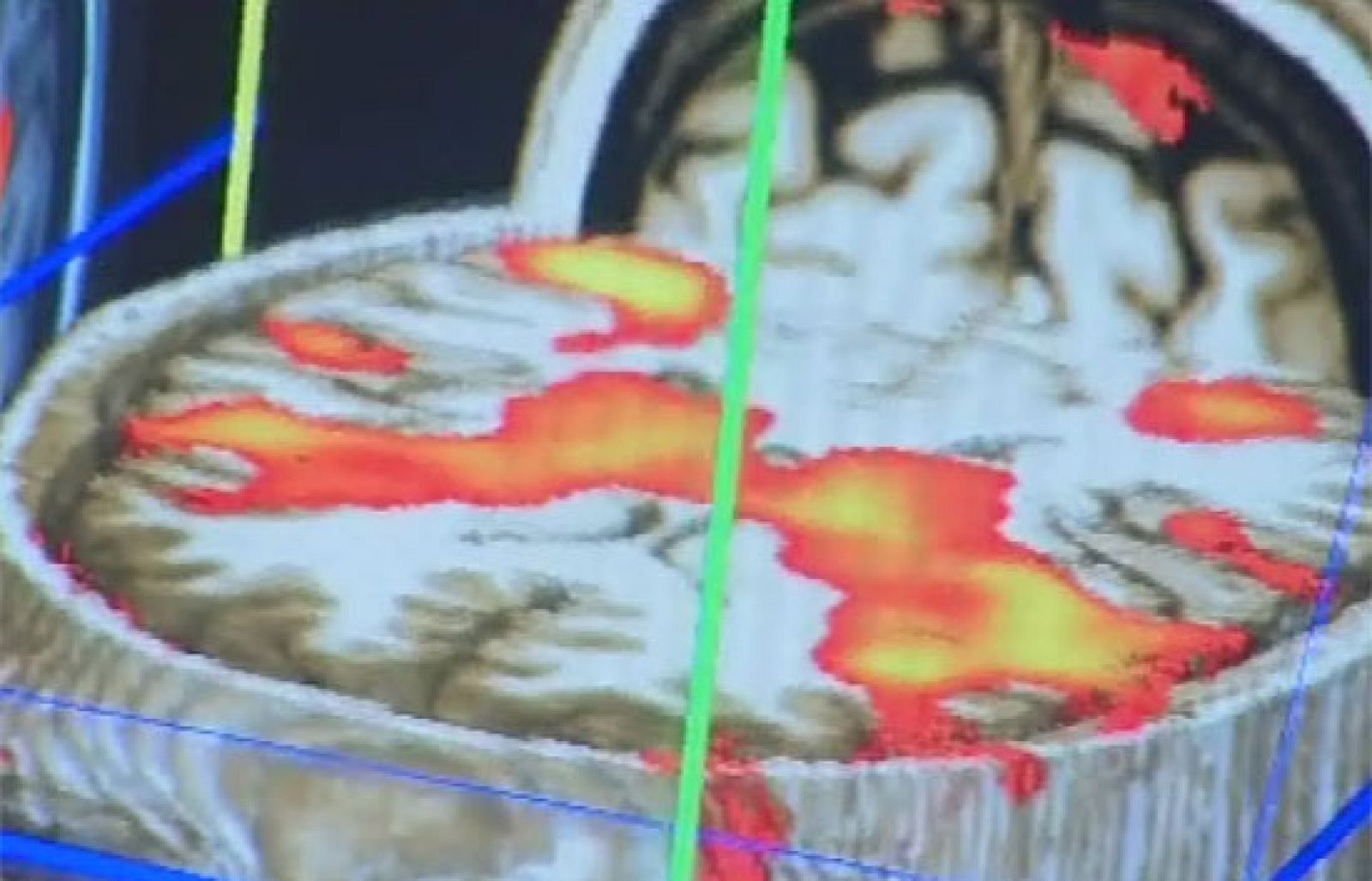 Una nueva tecnología de escáner cerebral detecta la parte del cerebro que activa su respuesta - Ciencia y tecnología en Rtve.es | Ver