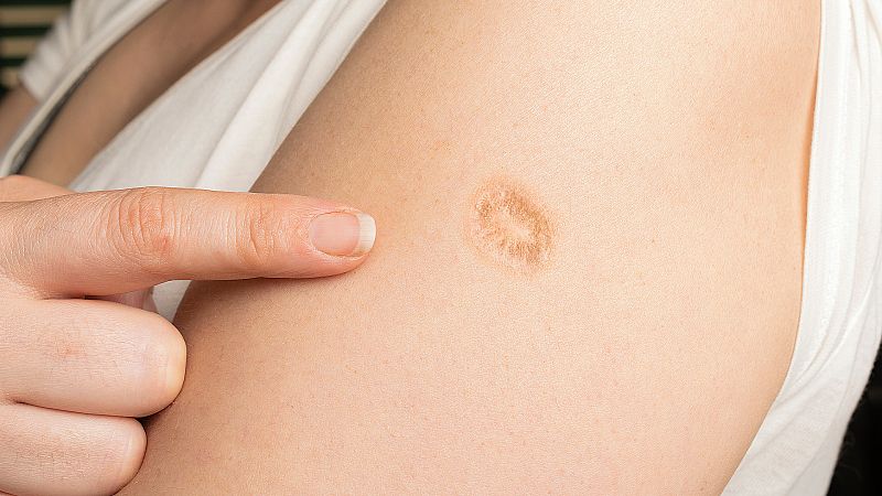 ¿Por qué personas de 40-50 años tienen esta marca en la piel?