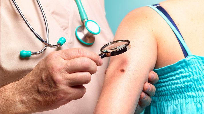 Telediario 2 - Buenos hábitos al sol como medida de protección ante los melanomas