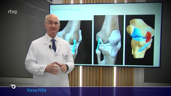 Telediario 2 - El 'virus FIFA', a examen en la consulta del doctor Ripoll