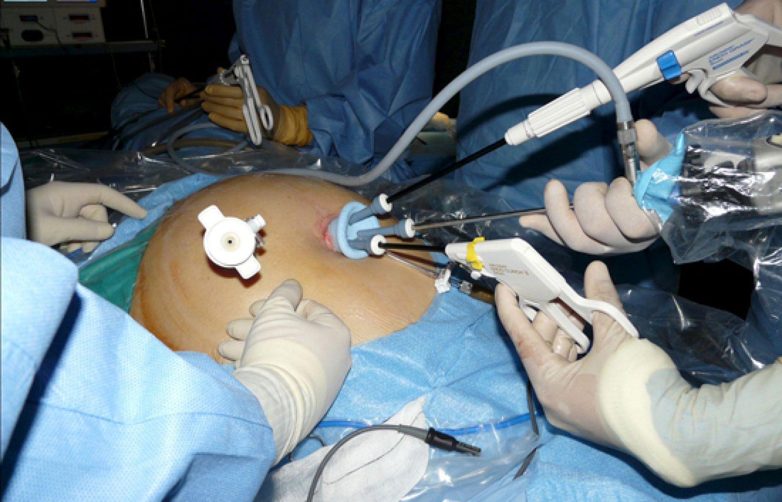 Las asociaciones de enfermos de cáncer de colon reivindican que la mejor medicina es la prevención - Ciencia y tecnología en Rtve.es | Ver