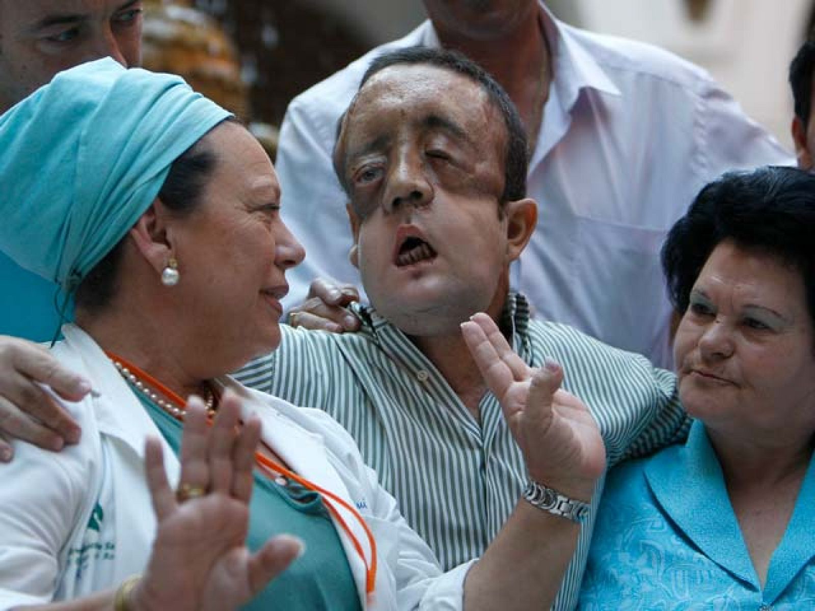 Exitoso trasplante de cara en el hospital Virgen del Rocío de Sevilla - Ciencia y tecnología en Rtve.es | Ver
