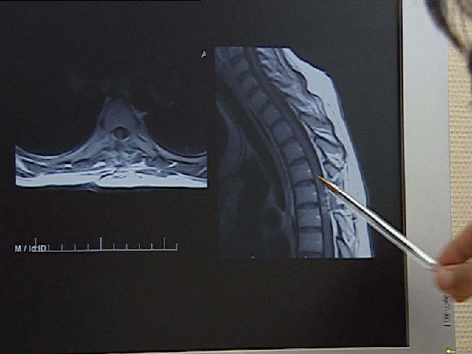 Los tratamientos con células madre que se ofrecen fuera de los ensayos clínicos oficiales no están autorizados y pueden ser perjudiciales - Ciencia y tecnología en Rtve.es | Ver