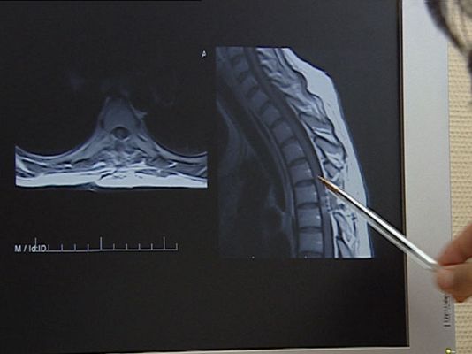 Ciencia y tecnología en Rtve.es - Tratamientos con células madre