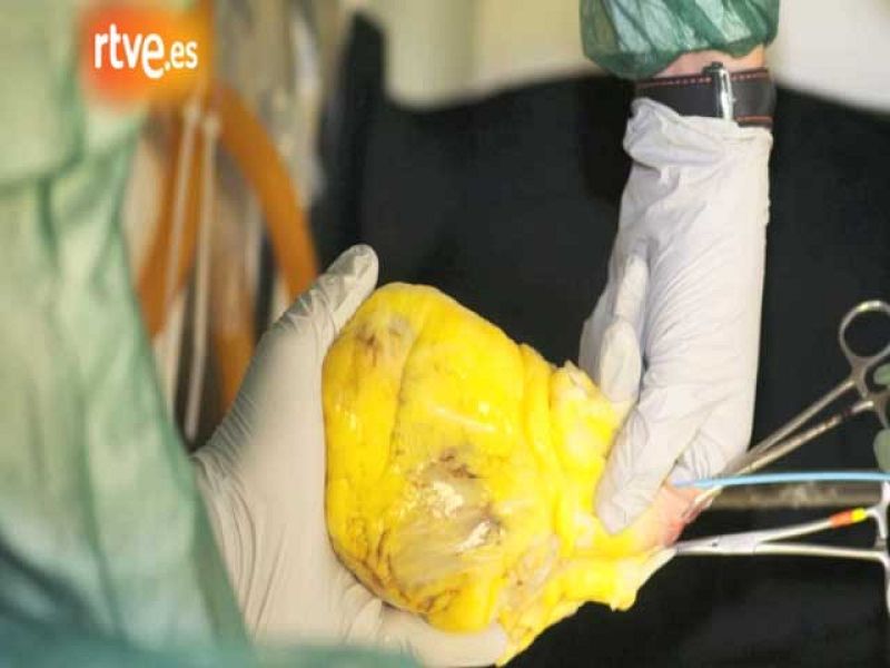 Cardiólogos españoles descelularizan un corazón humano, primer paso para crear uno bioartificial | Ver