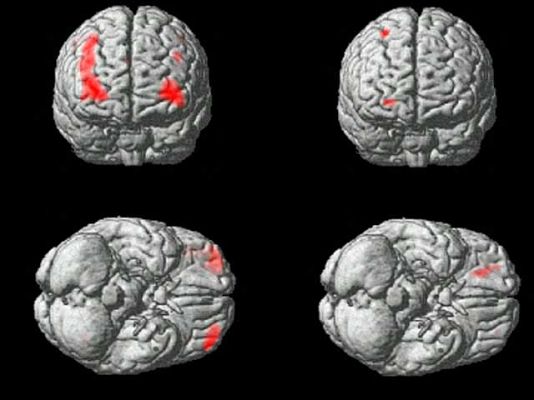  - Madrid cuenta con un nuevo banco de cerebros