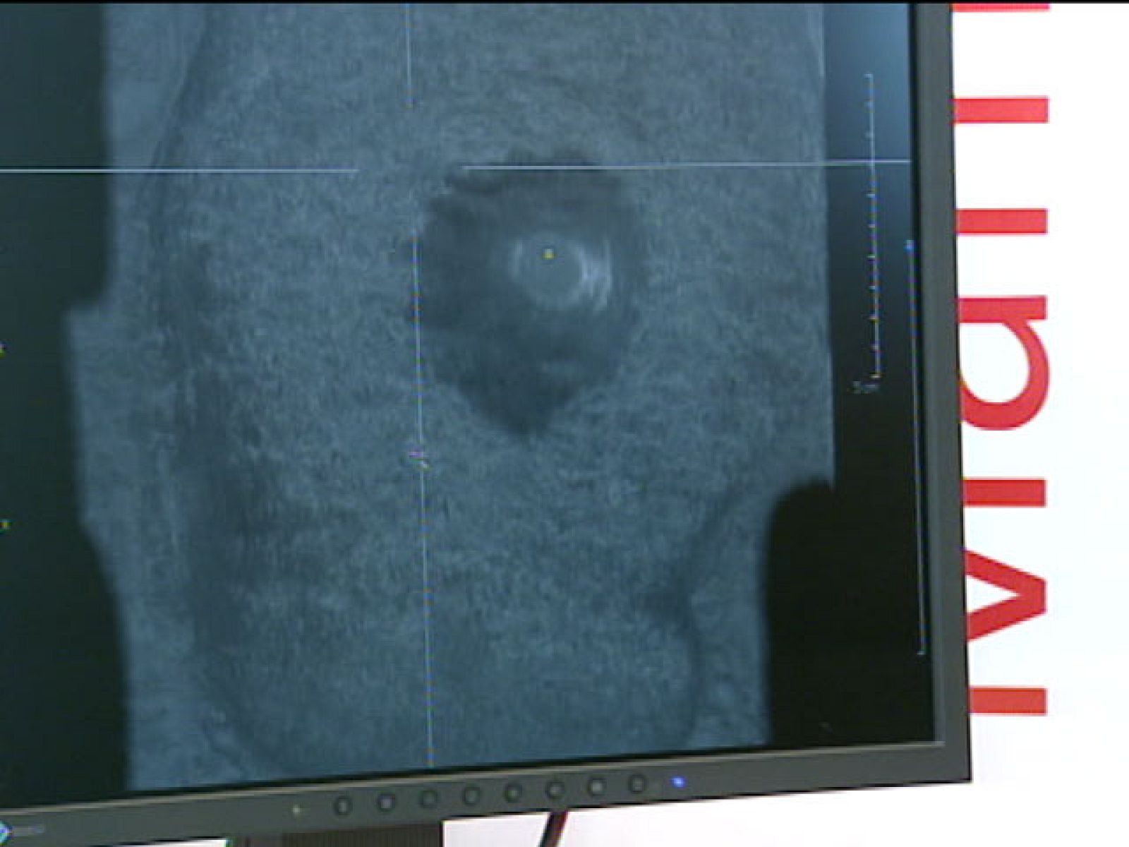 Congreso médico en Valencia en torno a problemáticas relacionadas con el cáncer - Ciencia y tecnología en Rtve.es | Ver