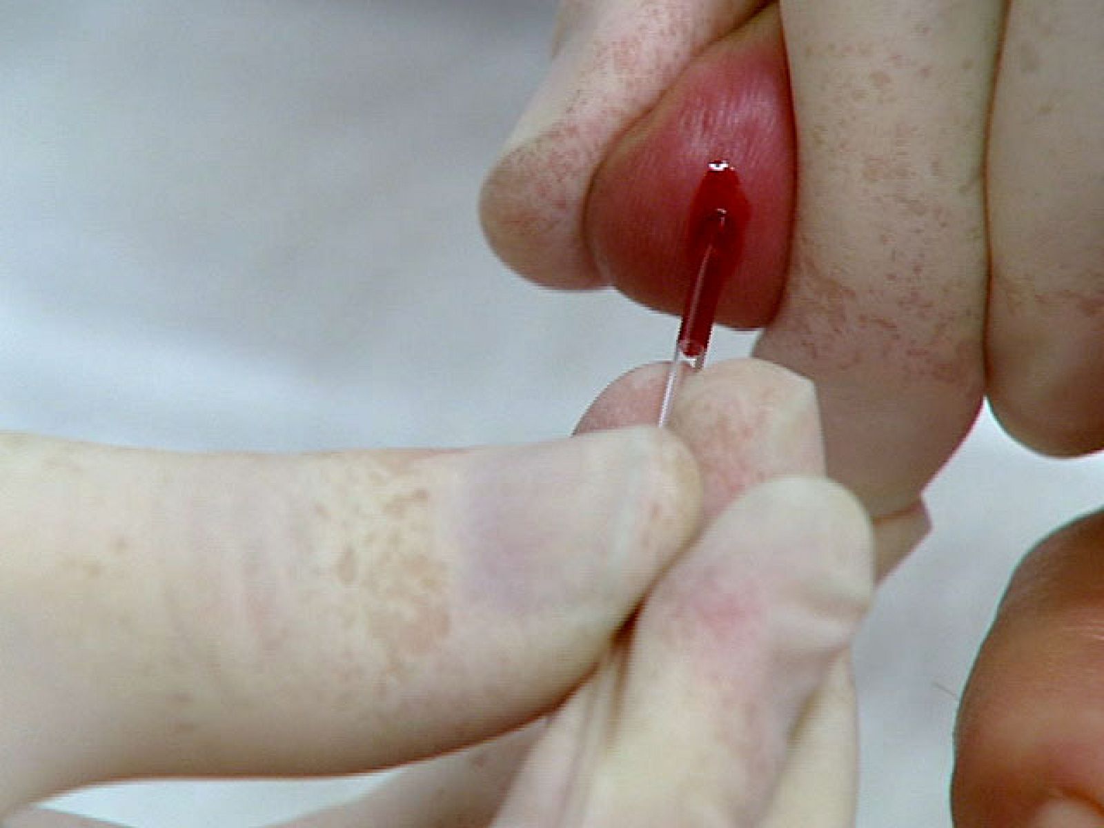 Prueba médica para conocer el riesgo de desarrollar cáncer de pulmón | Ver